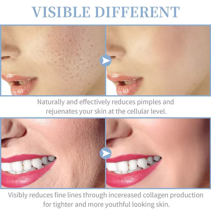 High Frequency Facial Device with 4 Electrodes