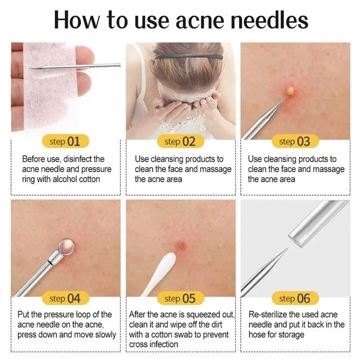 Stainless Steel Blackhead & Acne Extractor Set